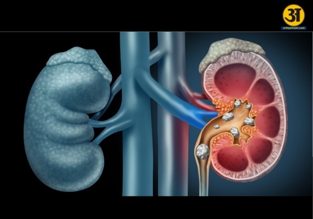 Acidity or kidney stones