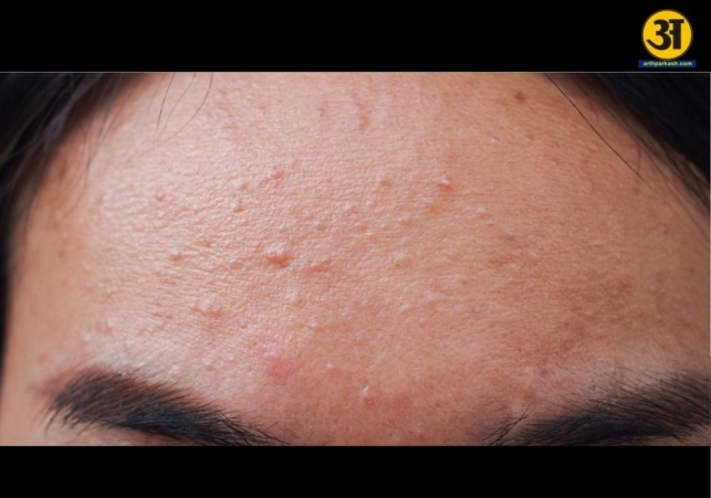 Acne or fungal acne