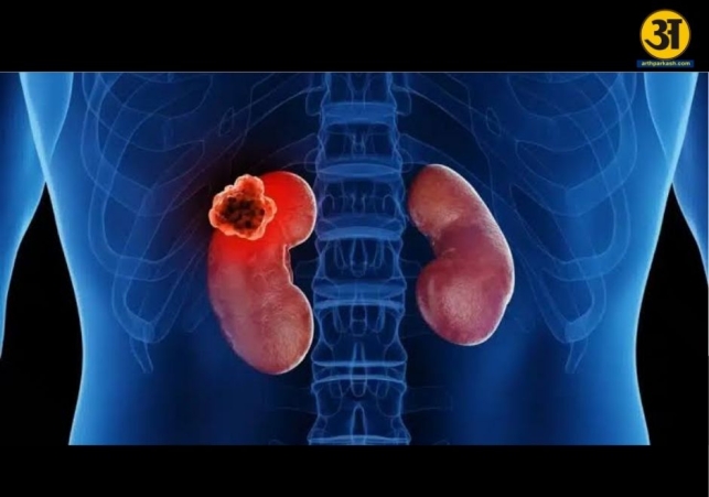 Blood in urine could be an early warning sign of kidney cancer