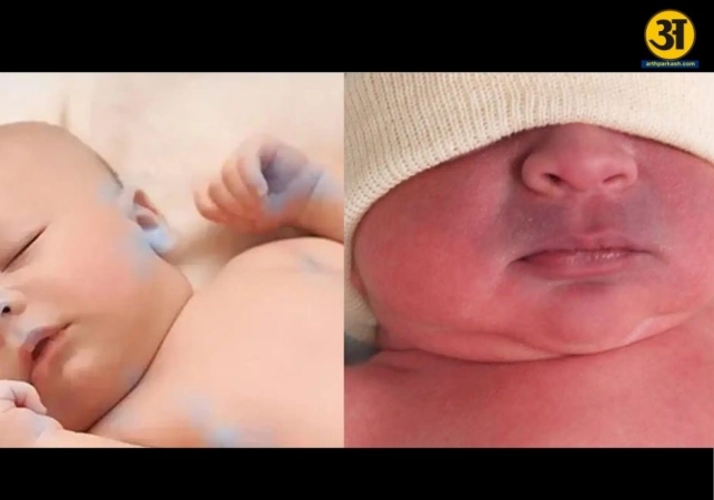 Blue baby syndrome in newborns