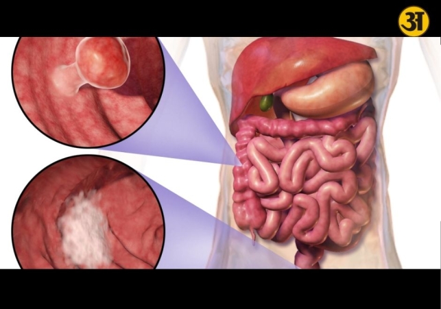 Colorectal cancer explained