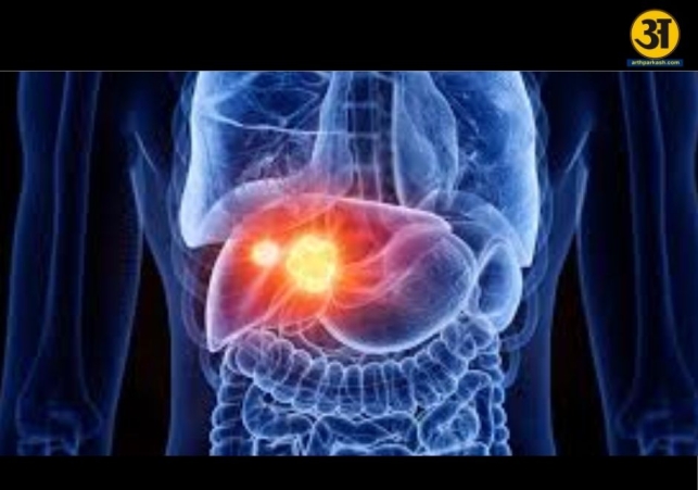 Liver cancer can affect anyone