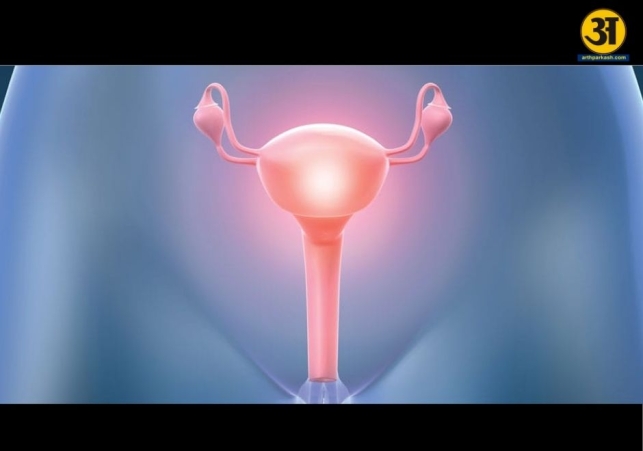 PCOS is striking younger