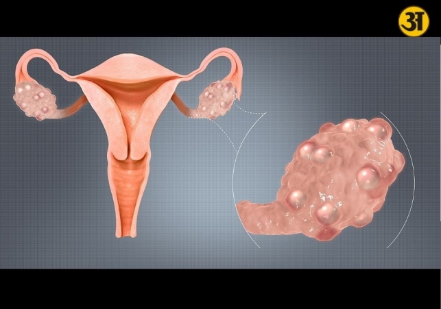 PCOS symptoms explained