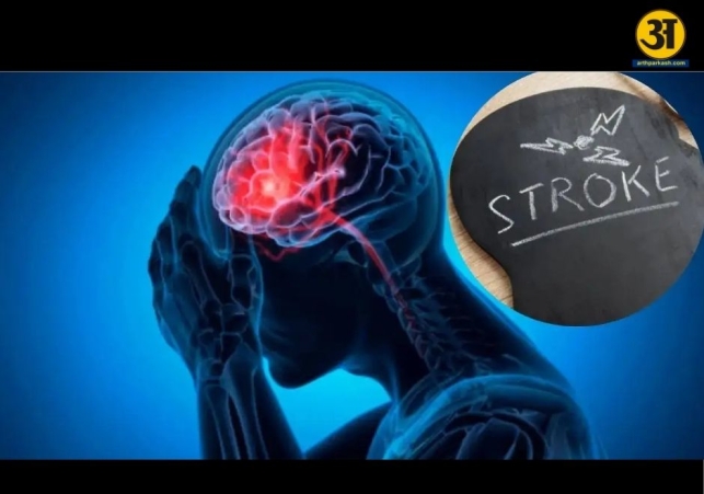 Why strokes can strike at any age 8 common myths busted