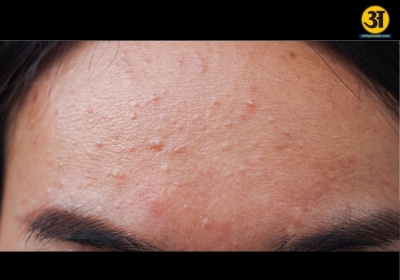Acne or fungal acne