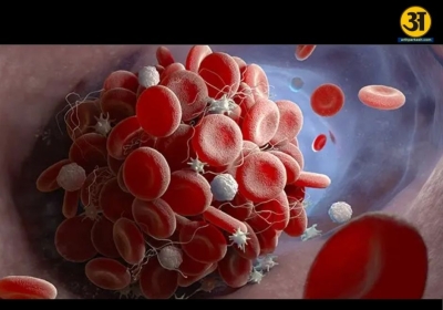 Blood clot dangers decoded