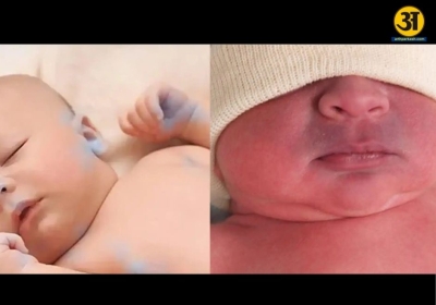 Blue baby syndrome in newborns