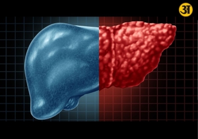 Can fatty liver be reversed without medicine