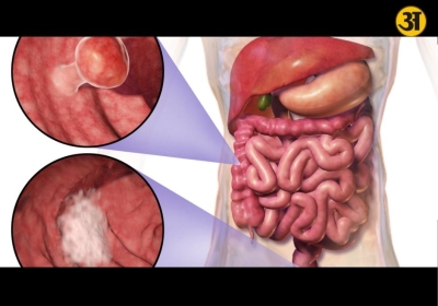 Colorectal cancer explained