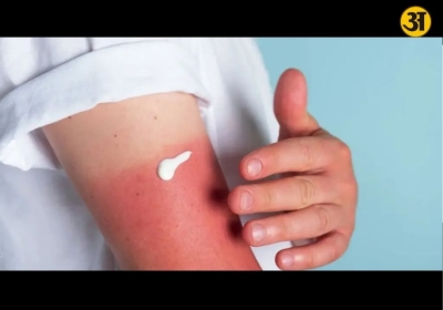 Doctors warn harsh sunlight may quietly damage skin beyond tanning