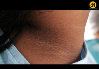 How teen obesity can lead to common skin issues