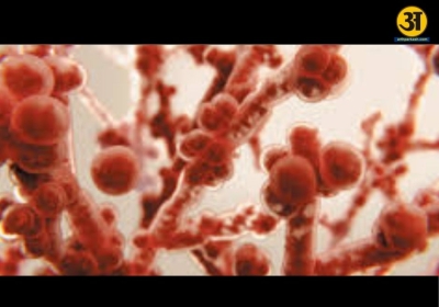 Invasive fungal infections can turn deadly if ignored early