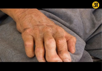 Leprosy is curable and not highly contagious