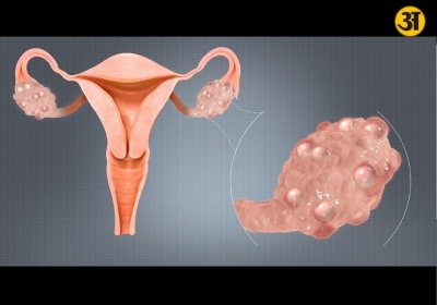 PCOS symptoms explained
