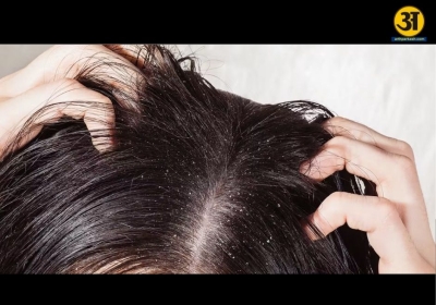 Why dandruff keeps coming back and what your scalp is trying to tell you