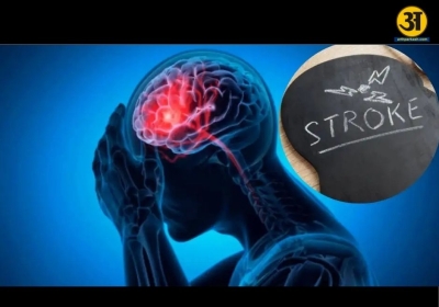 Why strokes can strike at any age 8 common myths busted